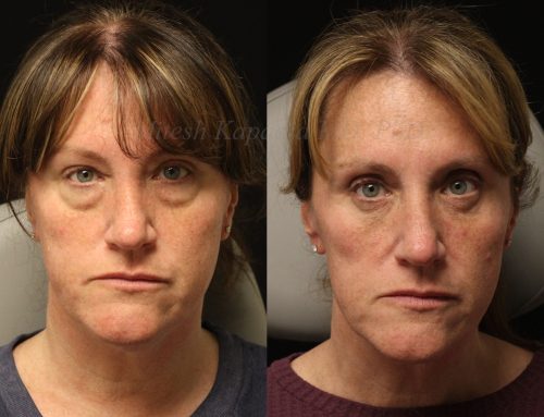 Before and 6 months after lower blepharoplasty surgery