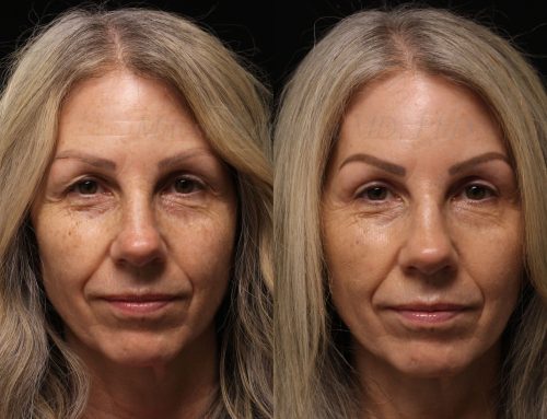 Before and 11 months after upper blepharoplasty surgery