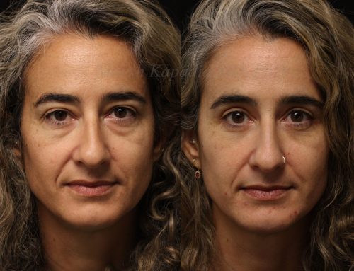 Before and 6 months after upper and lower blepharoplasty surgery