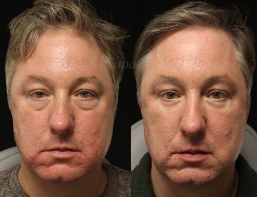 Before and 6 months after lower blepharoplasty surgery with lower lid CO2 laser resurfacing