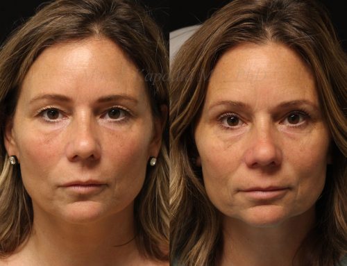 Before and 6 months after upper blepharoplasty surgery
