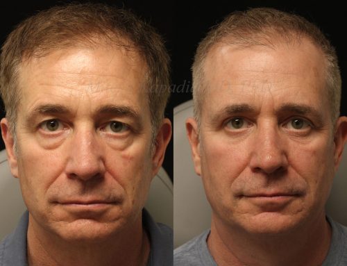 Before and 6 months after upper and lower blepharoplasty surgery with lower lid CO2 laser resurfacing