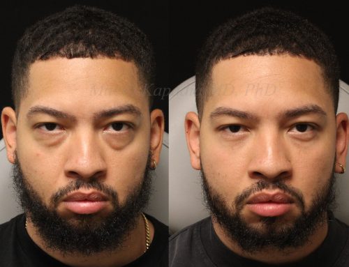 Before and 6 months after lower blepharoplasty surgery