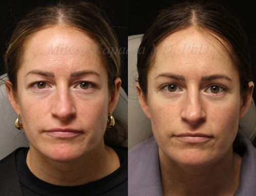 Before and 6 months after upper and lower blepharoplasty surgery with lower lid co2 laser resurfacing