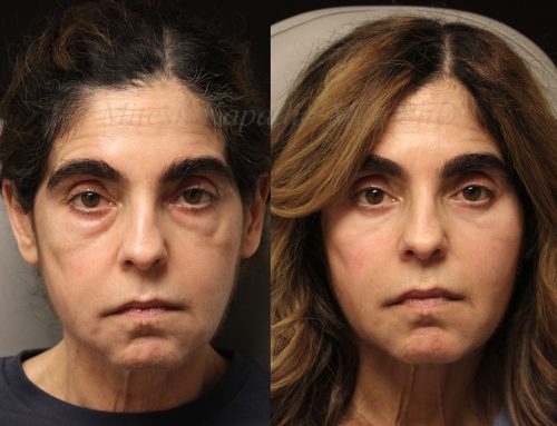 Before and 6 months after lower blepharoplasty surgery with lower lid co2 laser resurfacing