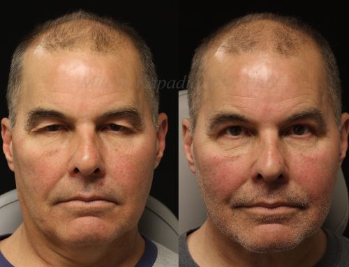 Before and 6 months after upper blepharoplasty surgery