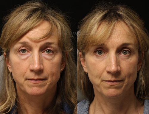 Before and 6 months after lower blepharoplasty surgery with lower lid CO2 laser resurfacing