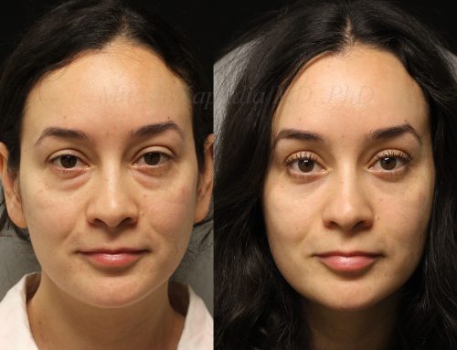 Before and 6 months after lower blepharoplasty surgery