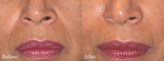 30s Woman – 3 Weeks Post-Treatment