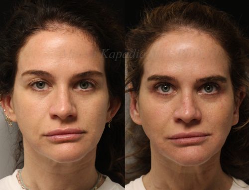 Before and 6 months after upper blepharoplasty surgery