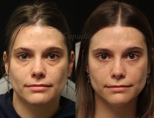 Before and 6 months after lower blepharoplasty surgery