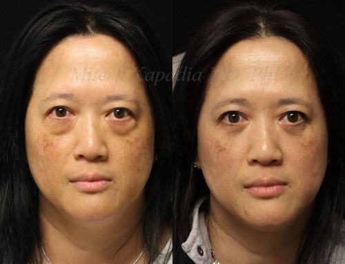 Before and 6 months after lower blepharoplasty surgery
