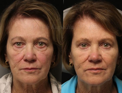 Before and 6 months after upper and lower blepharoplasty surgery with lower lid CO2 laser resurfacing