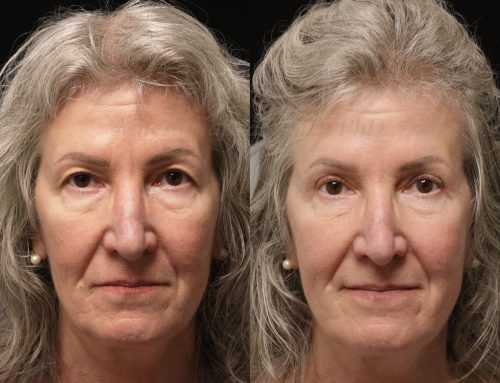 Before and 6 months after upper blepharoplasty surgery