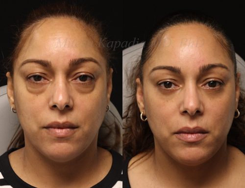 Before and 6 months after lower blepharoplasty surgery