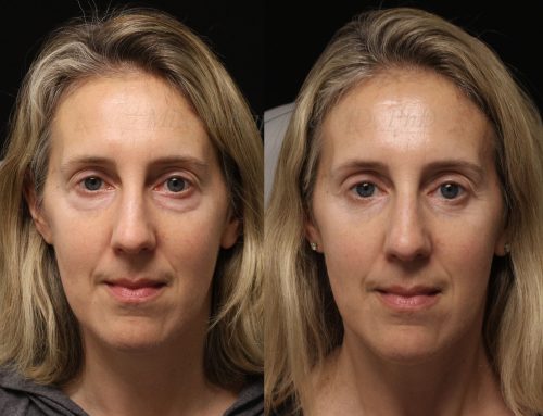 Before and 6 months after lower blepharoplasty surgery with lower lid CO2 laser resurfacing
