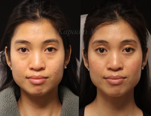 Before and 6 months after lower blepharoplasty surgery