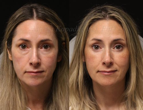 Before and 7 months after lower blepharoplasty surgery with lower lid CO2 laser resurfacing
