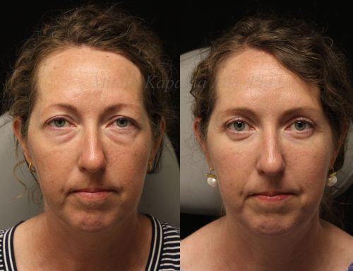 Before and 6 months after upper and lower blepharoplasty surgery