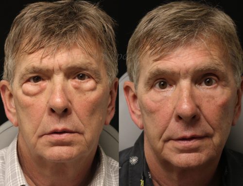 Before and 6 months after lower blepharoplasty surgery with lower lid CO2 laser resurfacing