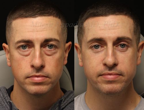 Before and 9 months after lower blepharoplasty surgery with lower lid CO2 laser resurfacing