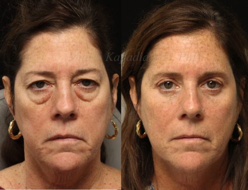 Before and 6 months after upper and lower blepharoplasty surgery with lower lid CO2 laser resurfacing