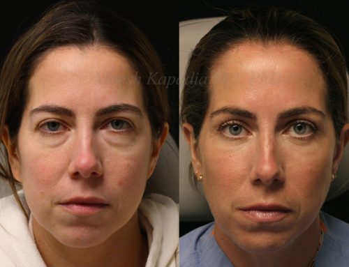 Before and 6 months after lower blepharoplasty surgery with lower lid CO2 laser resurfacing