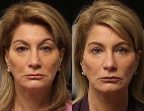 Before and 6 months after upper blepharoplasty surgery