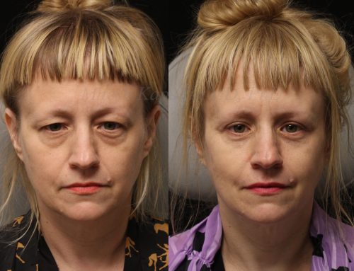 Before and 6 months after upper and lower blepharoplasty surgery with lower lid CO2 laser resurfacing