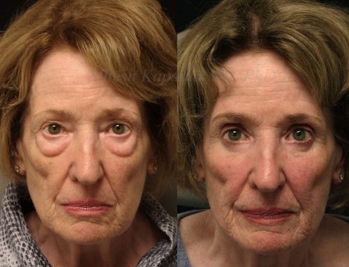 Before and 6 months after upper and lower blepharoplasty surgery with Lower lid CO2 laser resurfacing