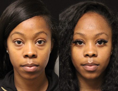 Before and 6 months after lower blepharoplasty surgery