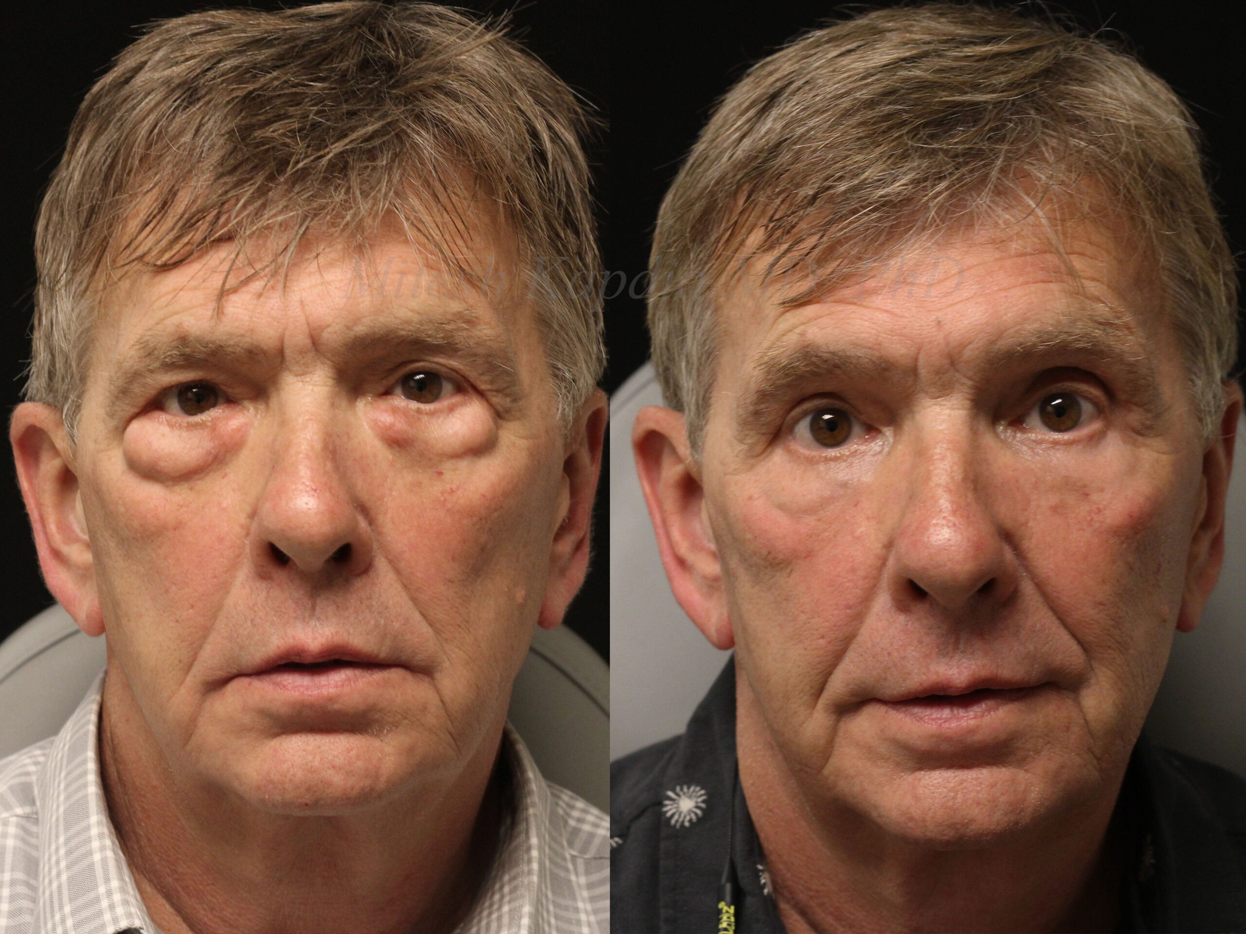 Lower Eyelid Surgery Before and After