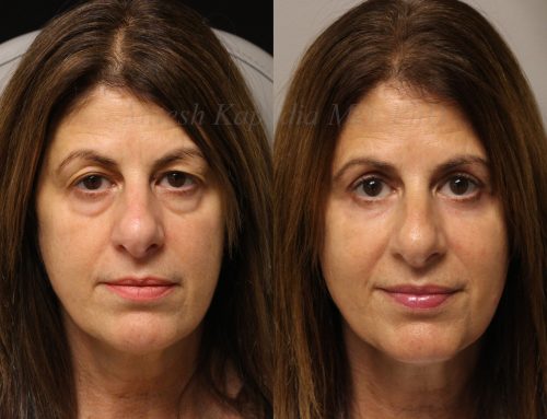 Before and 6 months after upper and lower blepharoplasty surgery with lower lid CO2 laser resurfacing