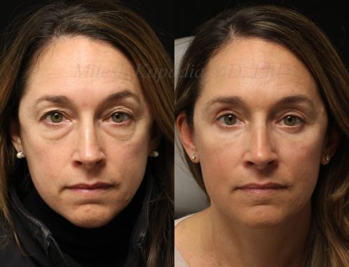 Before and 7 months after upper and lower blepharoplasty with lower lid CO2 laser resurfacing