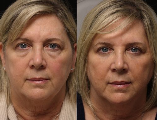 Before and 6 months after upper and lower blepharoplasty surgery with lower lid CO2 laser resurfacing
