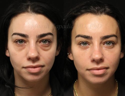 Before and 6 months after lower blepharoplasty surgery