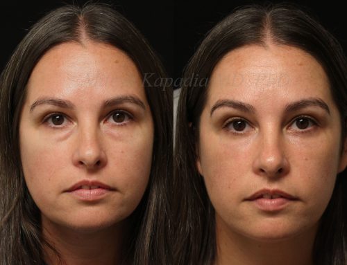 Before and 6 months after lower blepharoplasty surgery with lower lid CO2 laser resurfacing