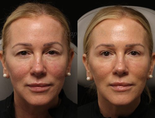 Before and 6 months after upper blepharoplasty surgery with lower lid co2 laser resurfacing